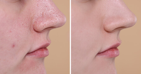 Blackhead treatment, before and after. Collage with photos of woman on beige background, closeup...