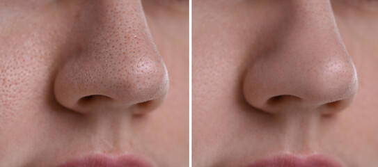 Blackhead treatment, before and after. Collage with photos of woman, closeup view