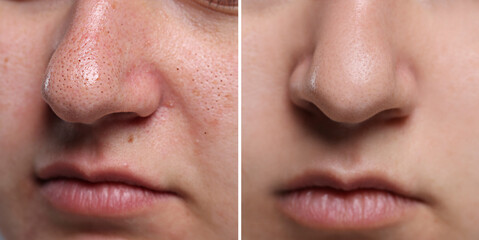 Blackhead treatment, before and after. Collage with photos of woman, closeup view