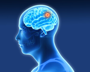 human brain tumor, 3D illustration showing presence of tumor inside brain