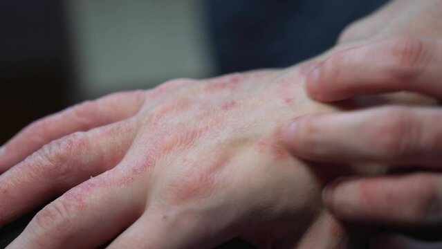 Close up of woman scratch hand with red psoriasis spot allergic reaction
