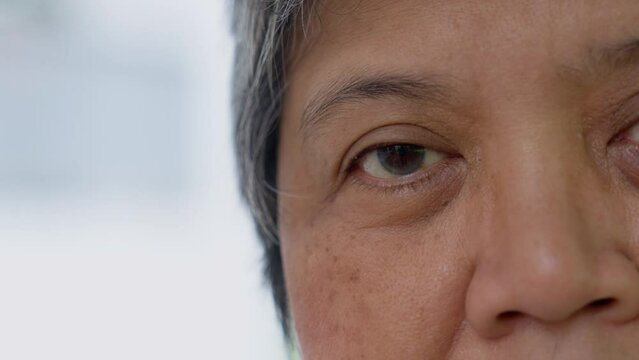 Close up of the senile cataract during eye examination. A white cloudy disc is seen in black eye circle, mature cataract, nuclear sclerosis cataract. Close up half face view