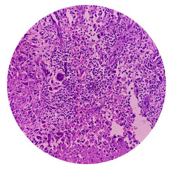 Cold abscess wall (biopsy). Chronic granulomatous inflammation (CGI) with Tuberculosis. CGI-TB. Section show multiple granulomas with Langhans' giant cells with chronic inflammatory cells.