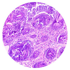 Rectal cancer. Rectum adenocarcinoma. IBD. IBS. Squamous cell carcinoma of the rectum. Grade 2 colorectal cancer, microscopic view.