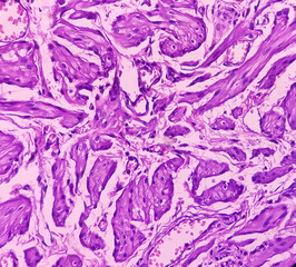 Ovarian cyst: Haemorrhagic cyst. Microscopic show ovarian cyst wall of fibrocollagenous tissue and lined by layers of haemosiderin-laden macrophages with blood, benign tumor.