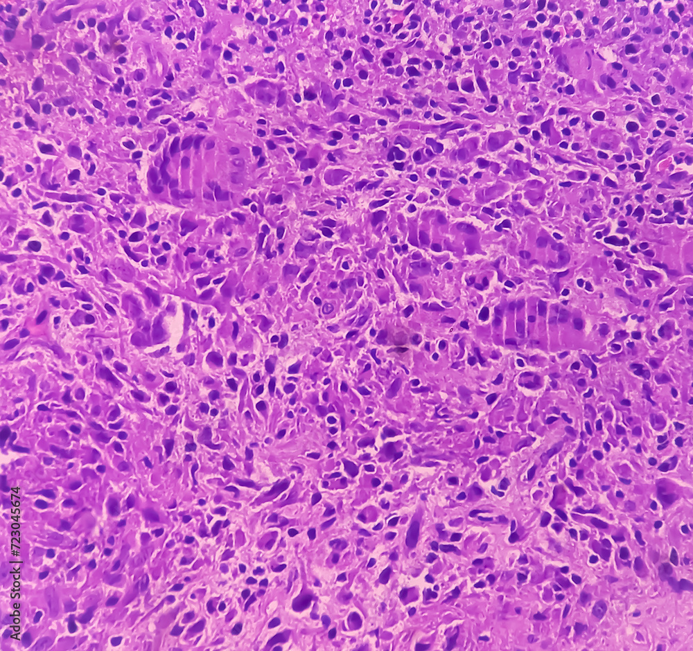 Poster Cold abscess wall (biopsy). Chronic granulomatous inflammation (CGI) with Tuberculosis. CGI-TB. Section show multiple granulomas with Langhans' giant cells with chronic inflammatory cells.