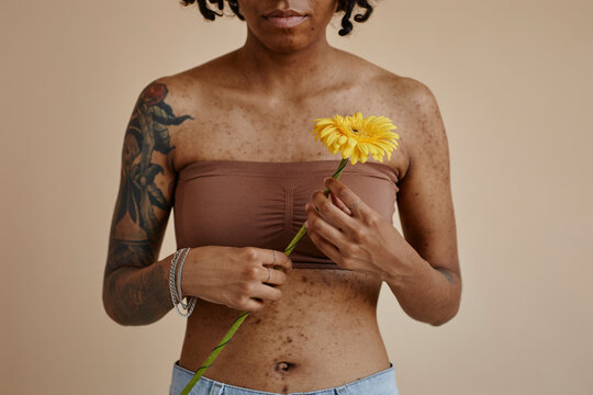 Woman with acne scars holding yellow flower against brown background