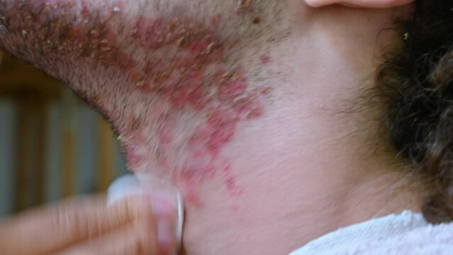 Skin care: Cotton pad, soaked in micellar water, is rubbed on the face of a young Caucasian with a seborrheic dermatitis problem. Personal care, pampering, beauty and relaxation.