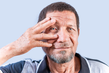Obraz premium Elderly person with irritated eyes. Senior man with eye pain isolated. Old man with conjunctivitis on white background