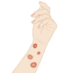 Cat fungus on the arm, allergy dermatitis, illustration on white background