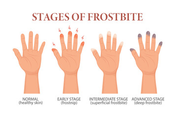 Fototapeta premium Frostbite stages. Frozen hands in different stages. Medical frostbite. Skin burn symptom. Health care medical concept. Vector