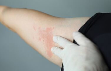 Close-up red rash on white skin hand, examination. Doctor touches an allergic rash with gloves....