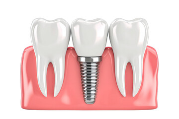 Implants and dental bridge with for installation and preserves isolated on transparent png background, fake teeth in dentistry, medicine and prosthesis.