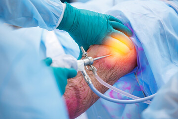 Doctor surgeon preparing patient leg before minimally invasive surgery, laparoscopic instrument for...