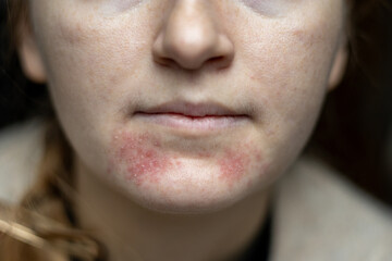 Fototapeta premium Perioral dermatitis on woman face. Closeup dermatitis on skin, ill allergic rash eczema skin of patient, atopic dermatitis symptom skin detail texture. The concept dermatology