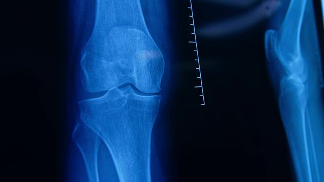 MRI scan of a knee on the light board. Close up.