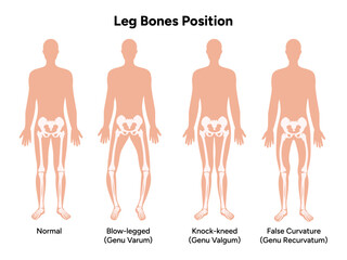 Leg bones position Blowlegged knock-kneed face curvature