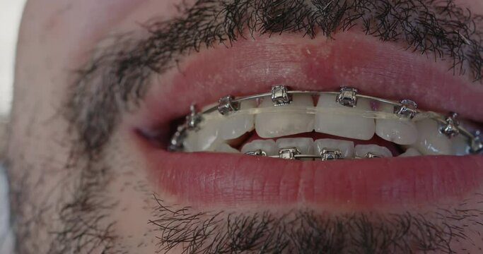 Close-up of a metal bracket system on white, even teeth. Braces for bearded man