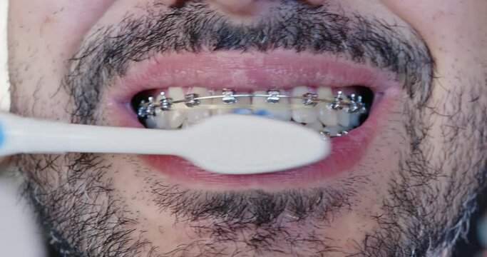 Cleaning metal braces with a toothbrush in longitudinal movements, shot close-up
