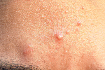 Close up face of teenage guy with Acne on the forehead and problem skin. Hormonal acne