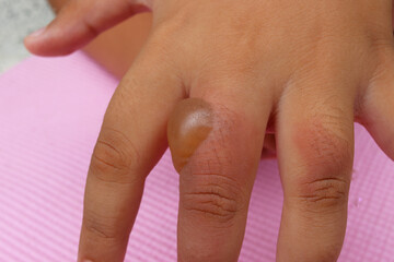 Patient's hand and thumb with heat blisters and injuries.from scalded hot water