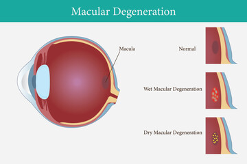 Age-related macular degeneration.Eye vision disorder. vector eps 10