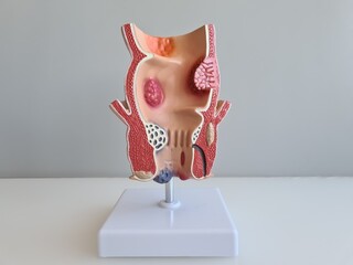 3D Model of Human Rectum with Hemorrhoids, Piles, Polyps Medical Education and Healthcare Use