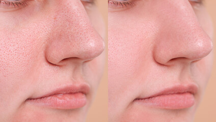 Blackhead treatment, before and after. Collage with photos of woman, closeup view