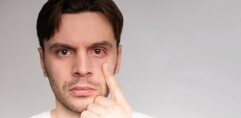Close up portrait of man with red eye before and after treatment or eye drop. Tired eyes and contact lenses. Dry eye, depression, sick, virus, sleepy..