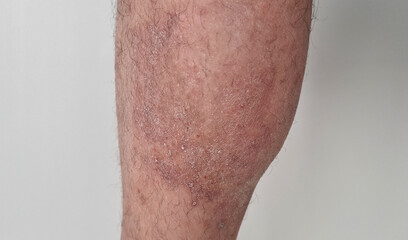 Dermatological skin disease and psoriasis on leg