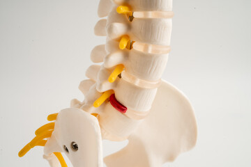 Lumbar spine displaced herniated disc fragment, spinal nerve and bone. Model for treatment medical...