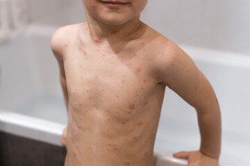Boy with chicken pox. Rash on child body close up