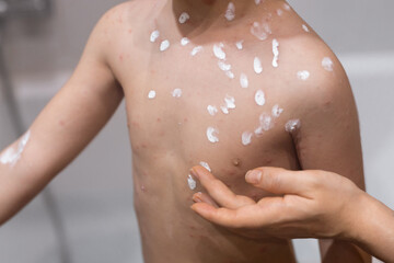 Woman applying cream onto skin of child ill with chickenpox, closeup