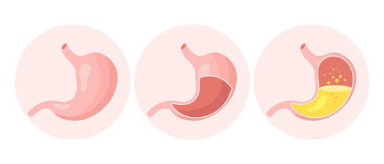Healthy and unhealthy, empty and full human stomach in flat style, icons set. Nutrition, stomach pain, bloating. Anatomy of the digestive system. Vector