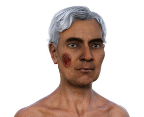 A man with cutaneous blastomycosis, 3D illustration