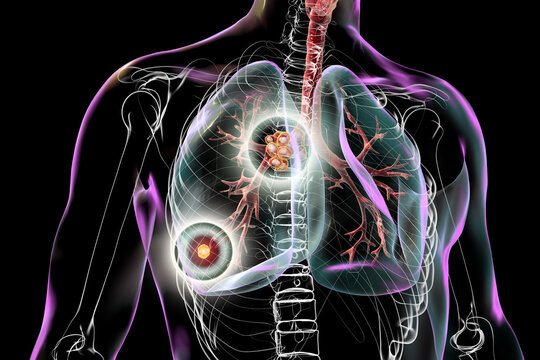 Primary lung tuberculosis with the Ranke complex, 3D illustration