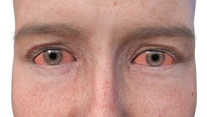 3D illustration portraying a person with dry eyes, a condition marked by insufficient tear production causing discomfort and irritation.