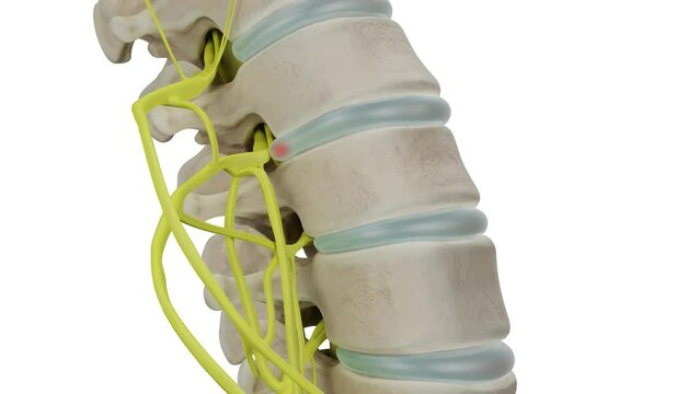 A herniated disc protrusion enlarges compressing a nerve root and causing pain. 3D animation isolated on a white background