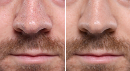 Blackhead treatment, before and after. Collage with photos of man, closeup view