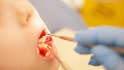 Close up cropped photo of curing healing operating teeth tooth, filling mouth cavity against caries...