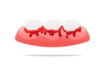 Bleeding teeth and gums vector isolated on white background.