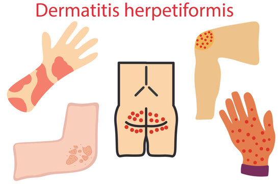 dermatitis herpetiformis,chemical exposure latex allergy the allergic itching,skin condition of coeliac disease,red, raised patches,burst with scratching,itching and often stinging,elbows,knees,five