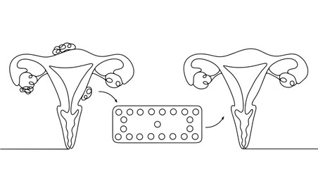 Endomitriosis. Uterus. Ovaries. Treatment. Hormones