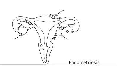 Endomitriosis. Gynecology. Uterus. Ovaries. Disease