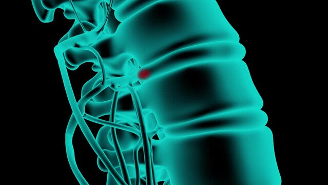 A herniated disc protrusion enlarges compressing a nerve root and causing pain. 3D x-ray animation isolated on a black background