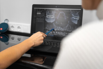 Dentist shows a 3D image of the jaw to the patient on a laptop screen. Modern technologies of...