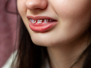 Teenager girl with pink color braces. Dentist procedure to straighten up teeth for better...