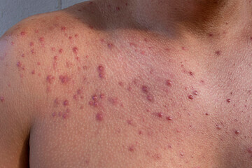 Allergy concept. male body with skin in pimples