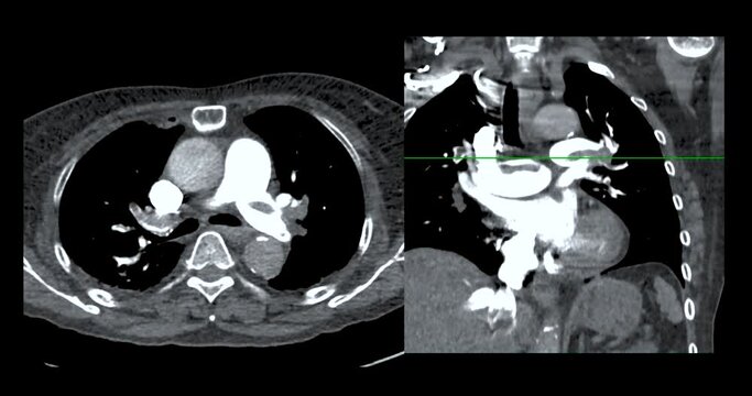 CTA pulmonary artery is a non-invasive imaging technique, providing detailed visuals of the pulmonary blood vessels in study case Showing A pulmonary embolism .