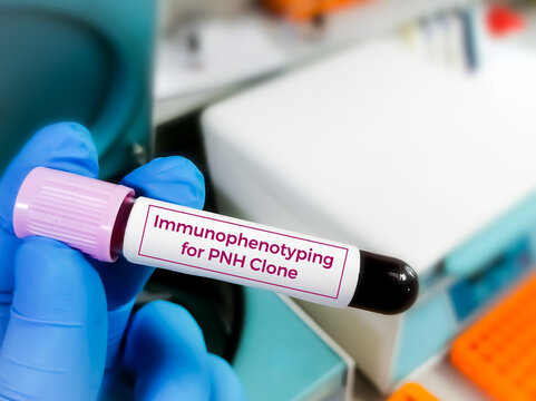 Flow cytometric Immunophenotyping for PNH (Paroxysmal nocturnal hemoglobinuria) clone.